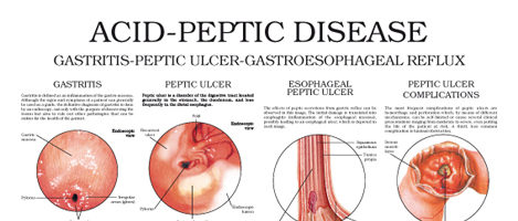 Acid Peptic Disease