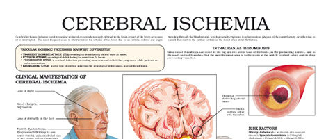 Cerebral Ischemia