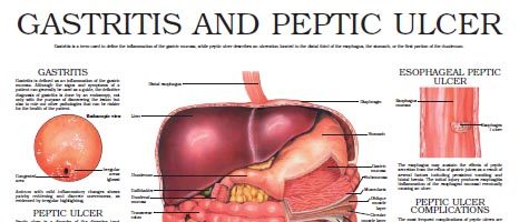 Gastritis and Peptic ulcer