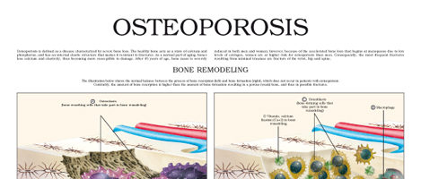 Osteoporosis (II)