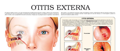 Otitis externa