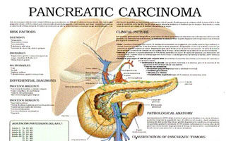 Pancreatic Carcinoma