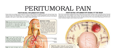 Peritumoral pain