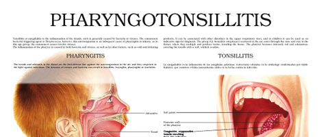 Pharyngotonsillitis