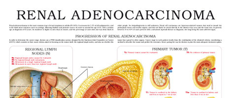 Renal adenocarcinoma