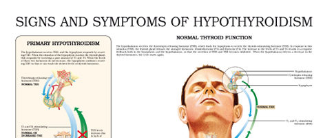 Signs and symptoms of Hypothyroidism