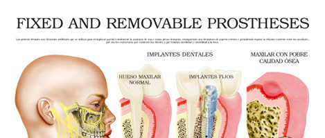 Fixed and removable prostheses