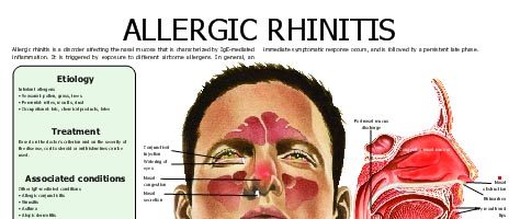 Allergic rhinitis