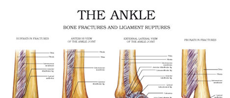 Ankle – Bone fractures and ligament ruptures