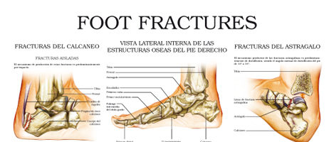 Foot fractures