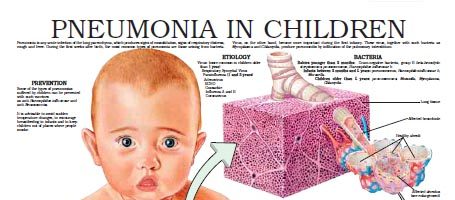 Pneumonia in children
