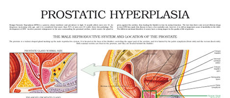 Prostatic hyperplasia