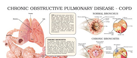 Chronic obstructive pulmonary disease – COPD
